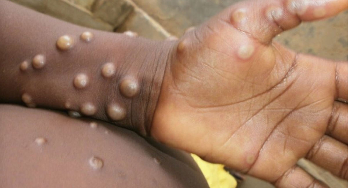 Israel reports 1st suspected case of monkeypox