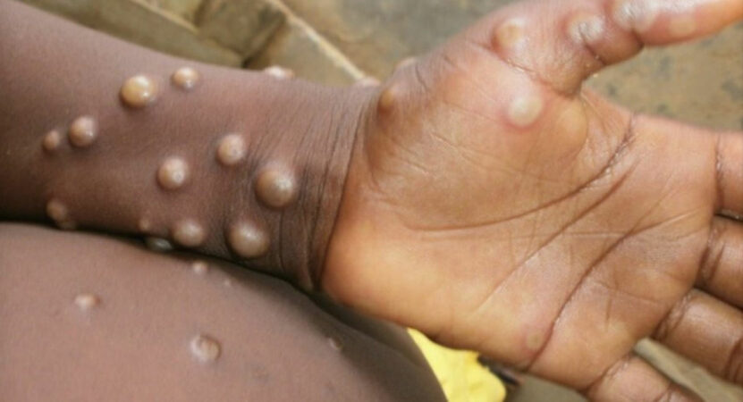 Europe’s red alert for monkeypox as nations told to prepare vaccination strategies
