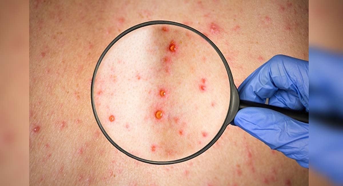 Massachusetts public health officials confirm case of monkeypox