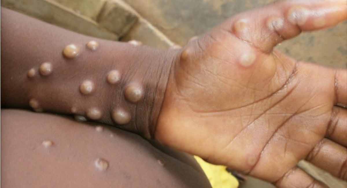 Monkeypox cases in UK pass 1,000, world total now 3,413