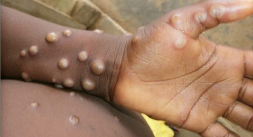Canada confirms 58 cases of monkeypox - Telangana Today